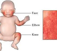 Baby atopic dermatitis eczema