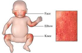 How to treat baby eczema
