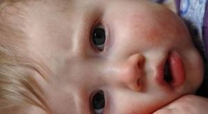 Eczema on babies face