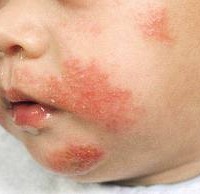 Baby atopic dermatitis