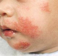 Nummular Eczema, The Unknown Eczema- Cure Your Babys Eczema