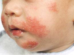 Baby atopic dermatitis